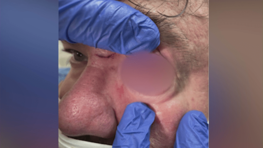 David Mermelstein damaged eye is seen in a photo provided by his attorney on May 31, 2023.