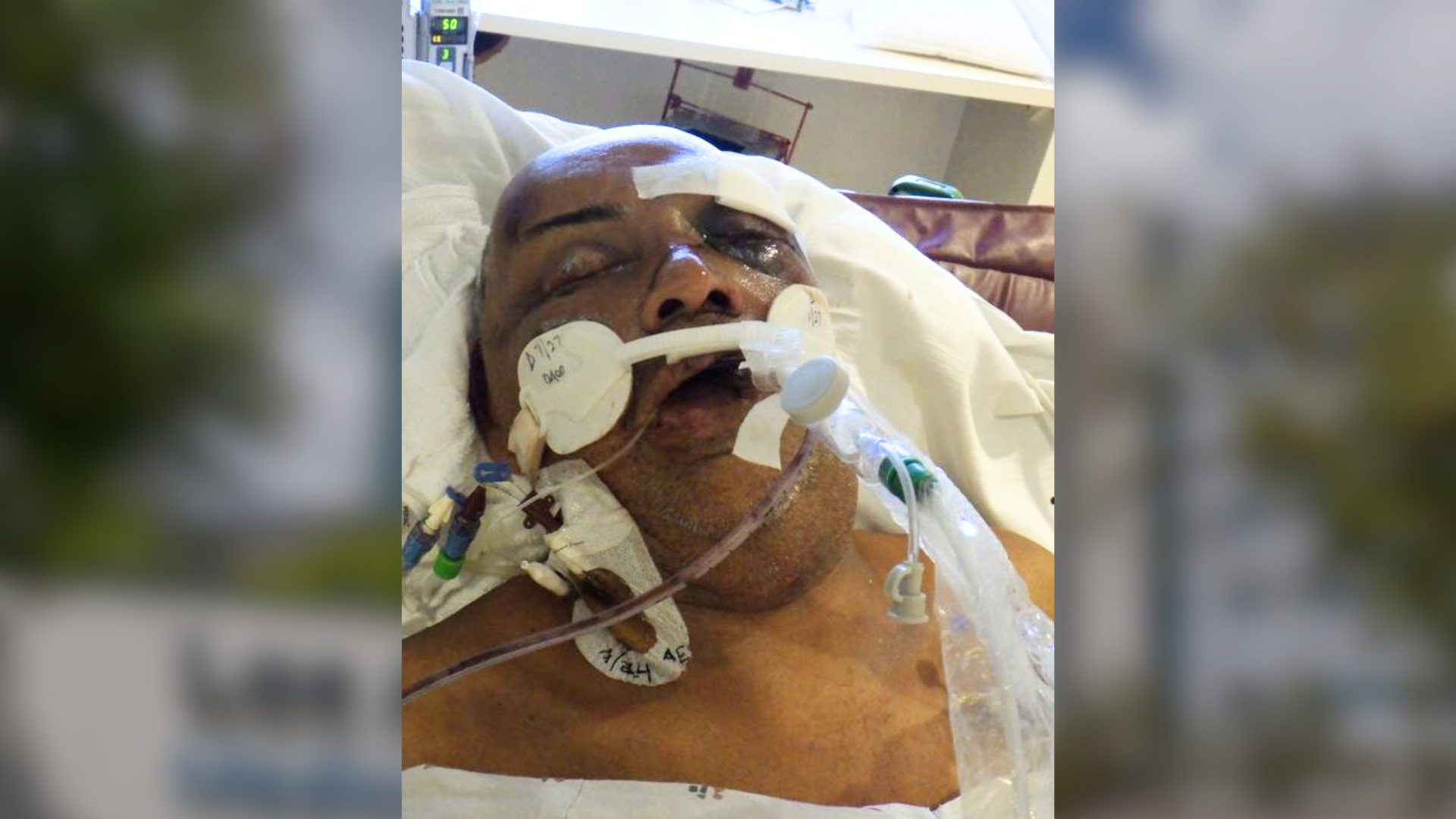An unidentified male patient in his 50s has been hospitalized at the Los Angeles General Medical Center since July 24, 2024. (Los Angeles General Medical Center)