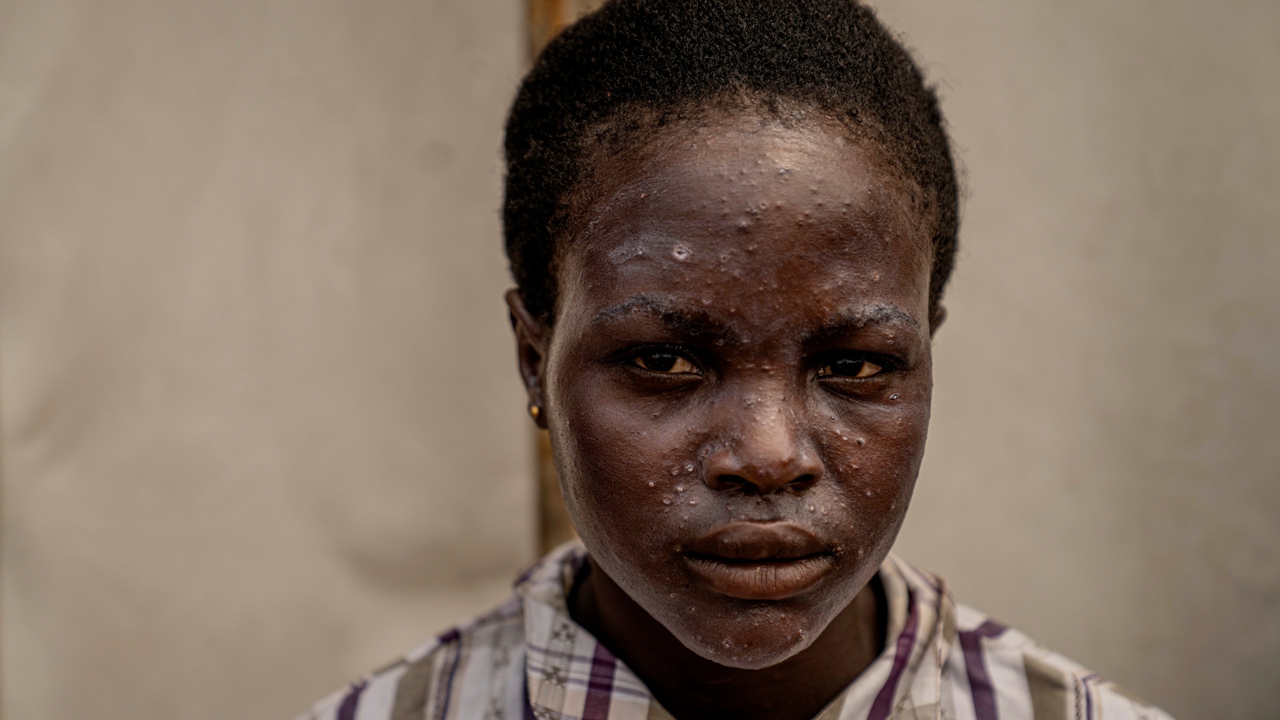 A young girl suffering from mpox waits for treatment at a clinic in Munigi, eastern Congo, Monday, Aug. 19, 2024. Congo will receive the first vaccine doses to address its mpox outbreak next week from the United States, the country's health minister said Monday, days after the World Health Organization declared mpox outbreaks in Africa a global emergency. (AP Photo/Moses Sawasawa)