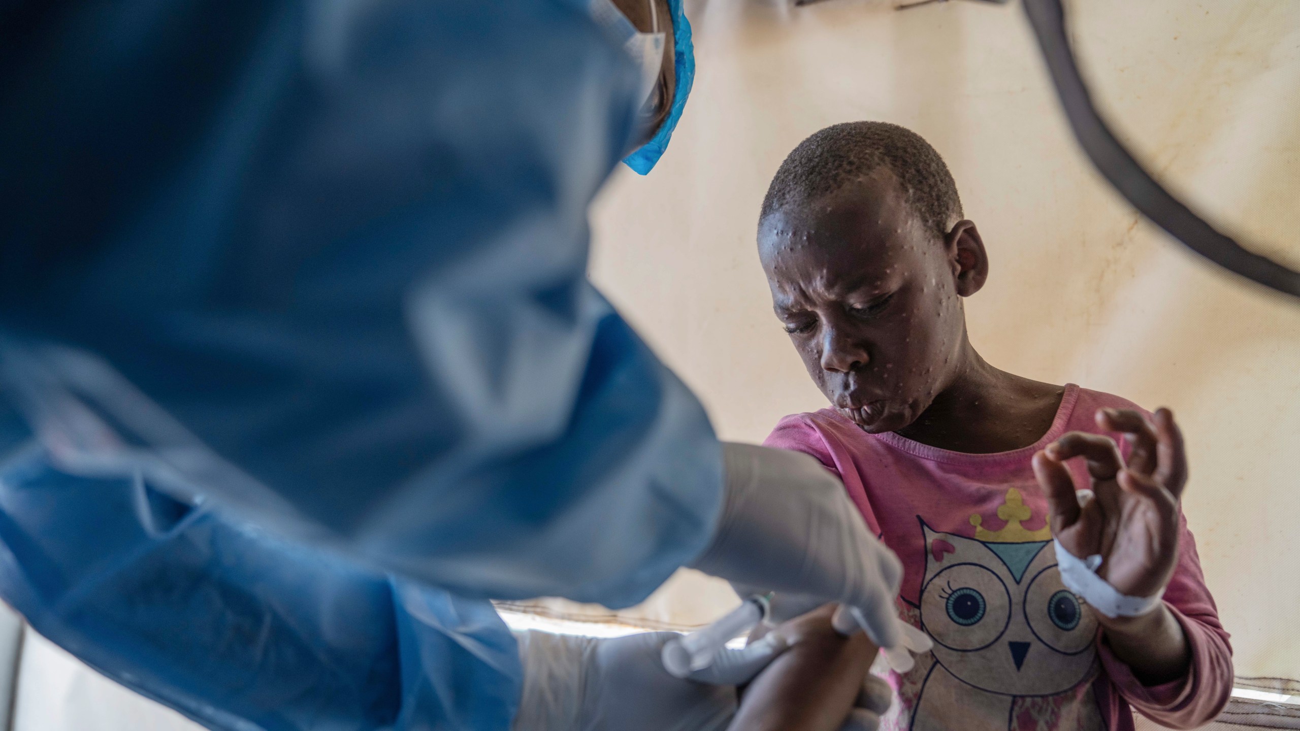 A health worker attends to a mpox patient, at a treatment centre in Munigi, eastern Congo, Monday, Aug. 19, 2024. Congo will receive the first vaccine doses to address its mpox outbreak next week from the United States, the country's health minister said Monday, days after the World Health Organization declared mpox outbreaks in Africa a global emergency. (AP Photo/Moses Sawasawa)