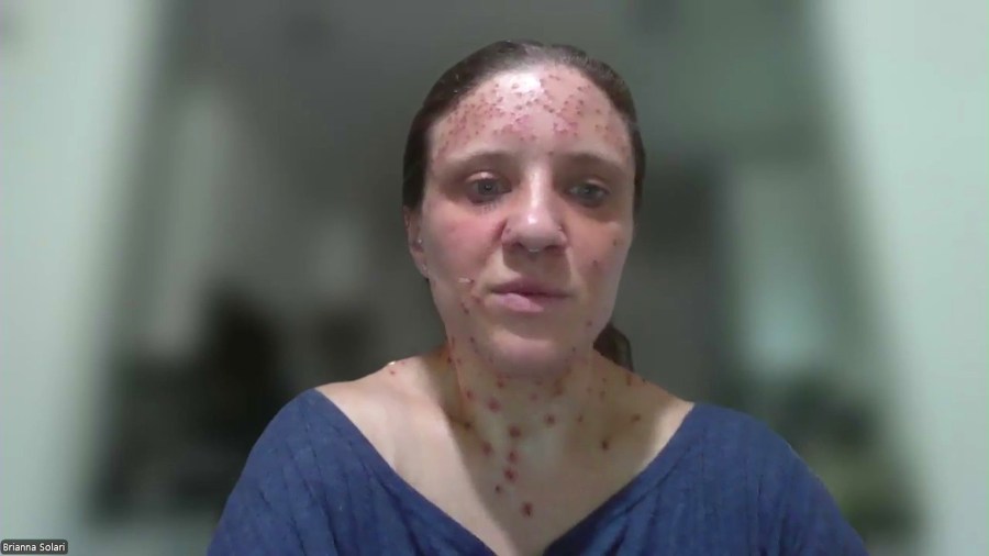 Brianna Solari has a rare genetic condition called neurofibromatosis which causes tumors to grow all over the skin and nervous system. (KTLA)