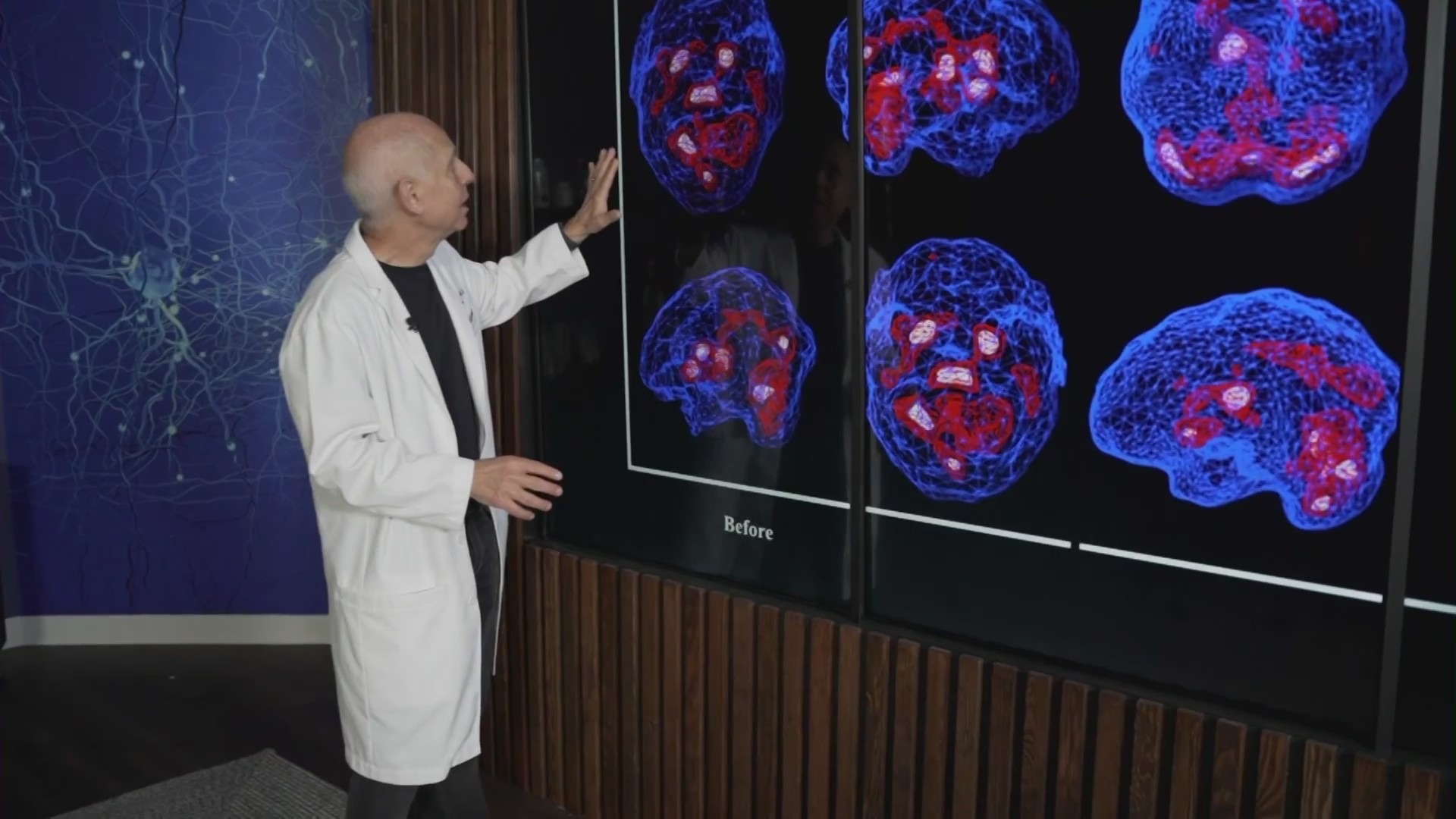 Dr. Daniel Amen shows the SPECT scan images of Matt Fiorenza’s brain that reveal an increased level of emotional activity. (KTLA)