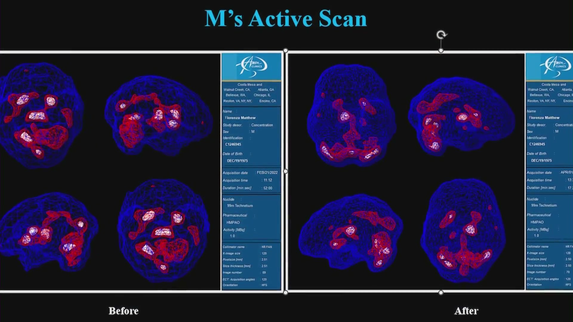 After two years of treatment, the before-and-after SPECT images of Matt Fiorenza’s brain show a decreased level of emotional activity. (KTLA)
