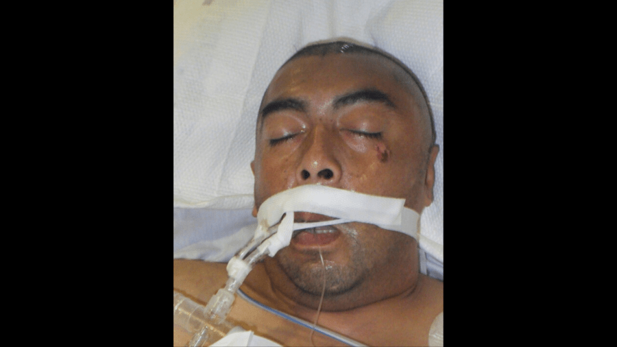 A male patient around 41 years old who was struck by a car near Helman Avenue and Atlantic Boulevard in Alhambra and has been hospitalized since Jan. 26, 2025. (Los Angeles General Medical Center)