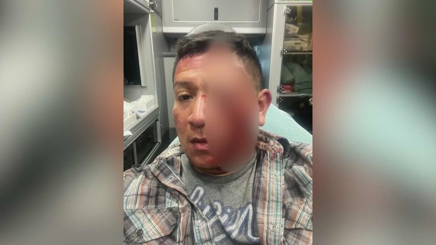 Javier Ibarra's bruised and bloodied face is seen after a man violently punched and beat him outside his Inglewood home while yelling racial slurs on April 15, 2025. (Javier Ibarra)