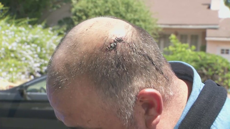 Rodolfo Roman received multiple staples to his head and was left with a broken arm following the brutal assault. (KTLA)