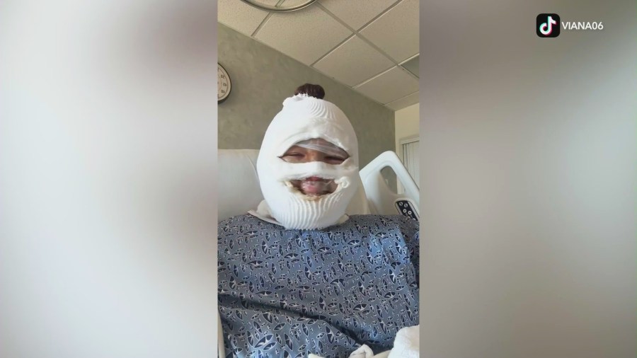 Viana Poggi, 18, was hospitalized with second and third-degree burns after flames exploded from a tabletop fire pit on July 6, 2025. (Poggi Family)