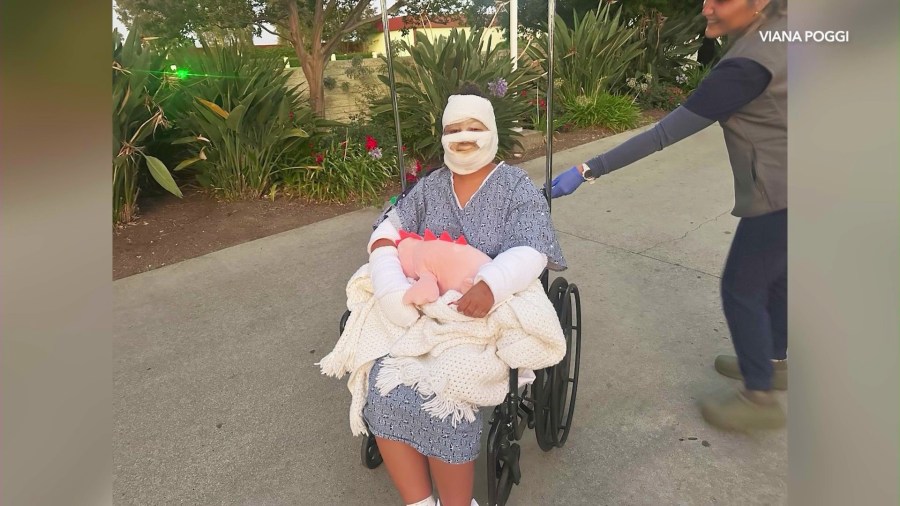 Viana Poggi, 18, was hospitalized with second and third-degree burns after flames exploded from a tabletop fire pit on July 6, 2025. (Poggi Family)