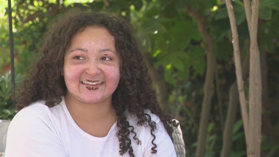 Vianna Poggi is choosing to look on the bright side after recovering from a burn accident while using a table top fire pit at her home. (KTLA)
