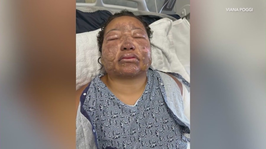 Viana Poggi, 18, was hospitalized with second and third-degree burns after flames exploded from a tabletop fire pit on July 6, 2025. (Poggi Family)